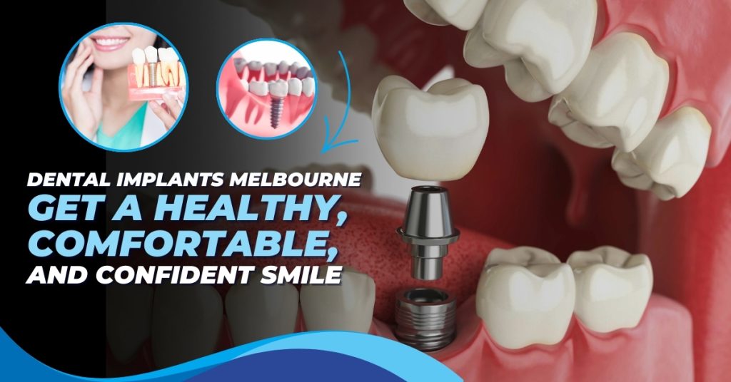 dental implants melbourne