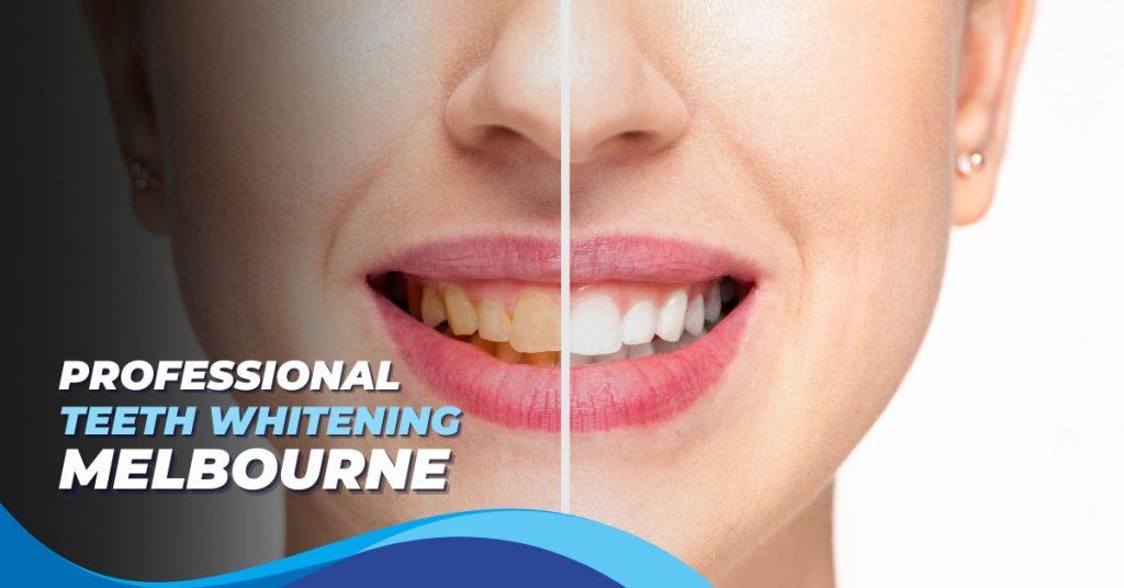 teeth whitening melbourne