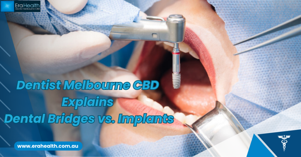 Dental Bridges
