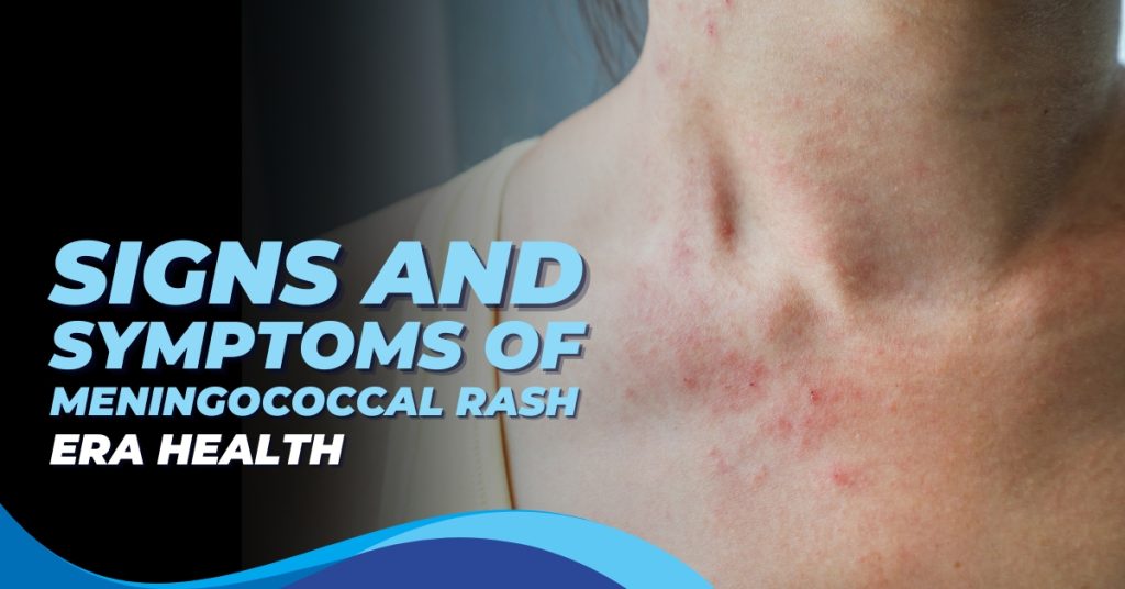Meningococcal Rash