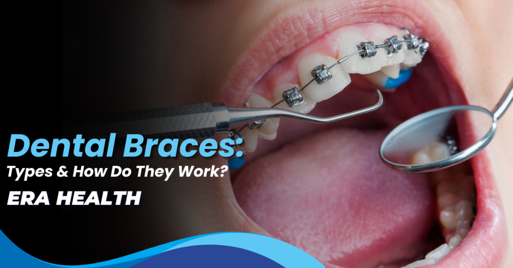 Dental Braces