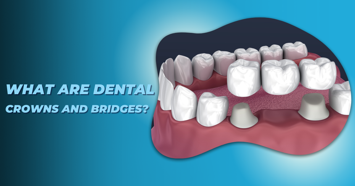 Dental Crowns and Bridges
