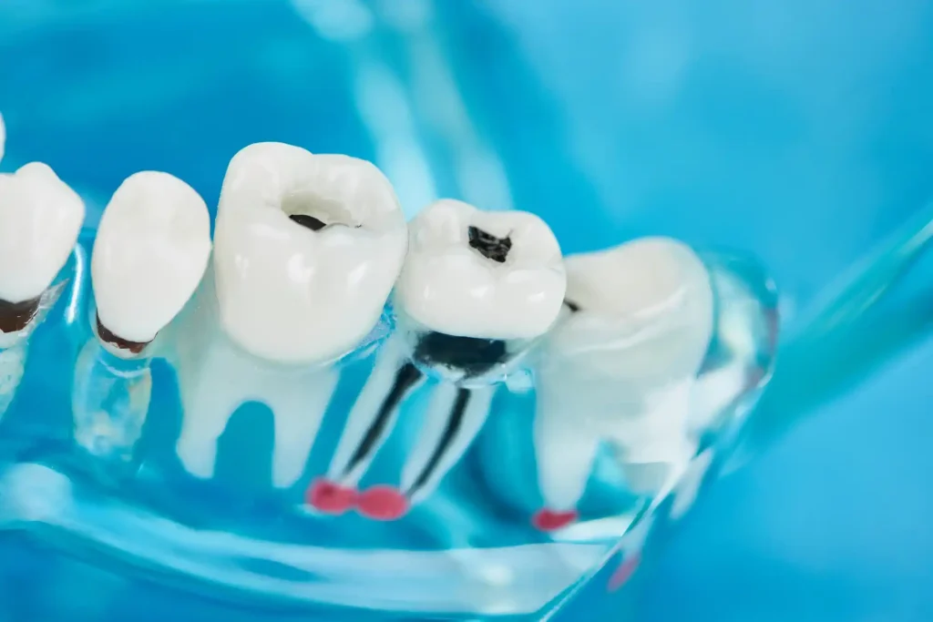 Root Canal