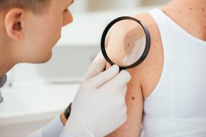 Skin Cancer Checks