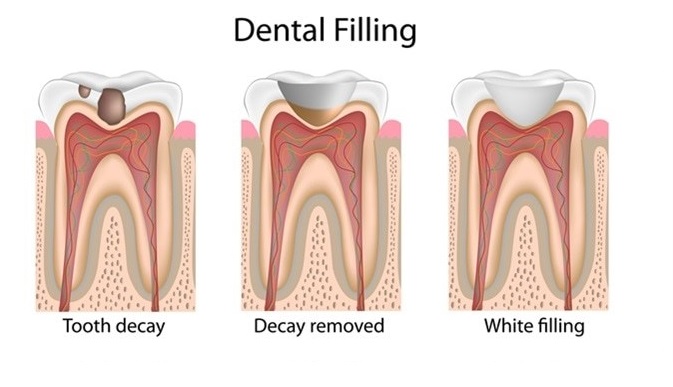 Dental-Filling-White