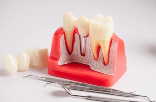 Dental-implan