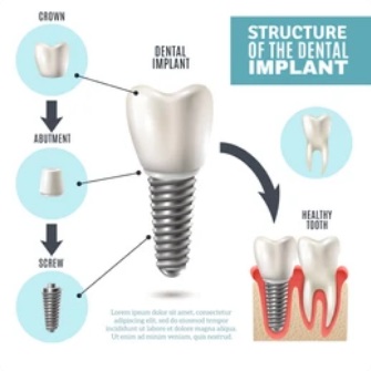 Dental-implant-process