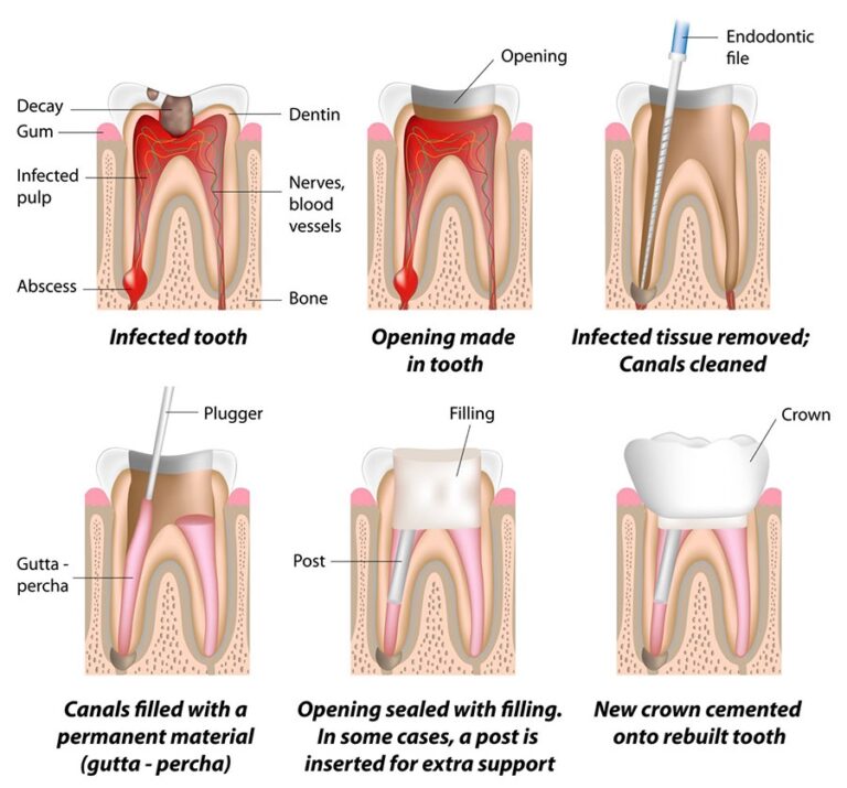Root-Canal-Procedure
