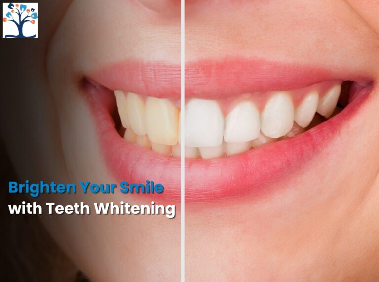 before-and-after-teeth-whitening
