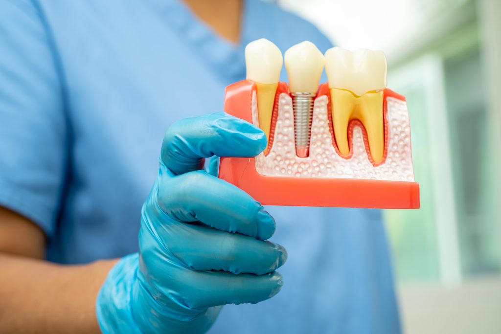 Dental implant