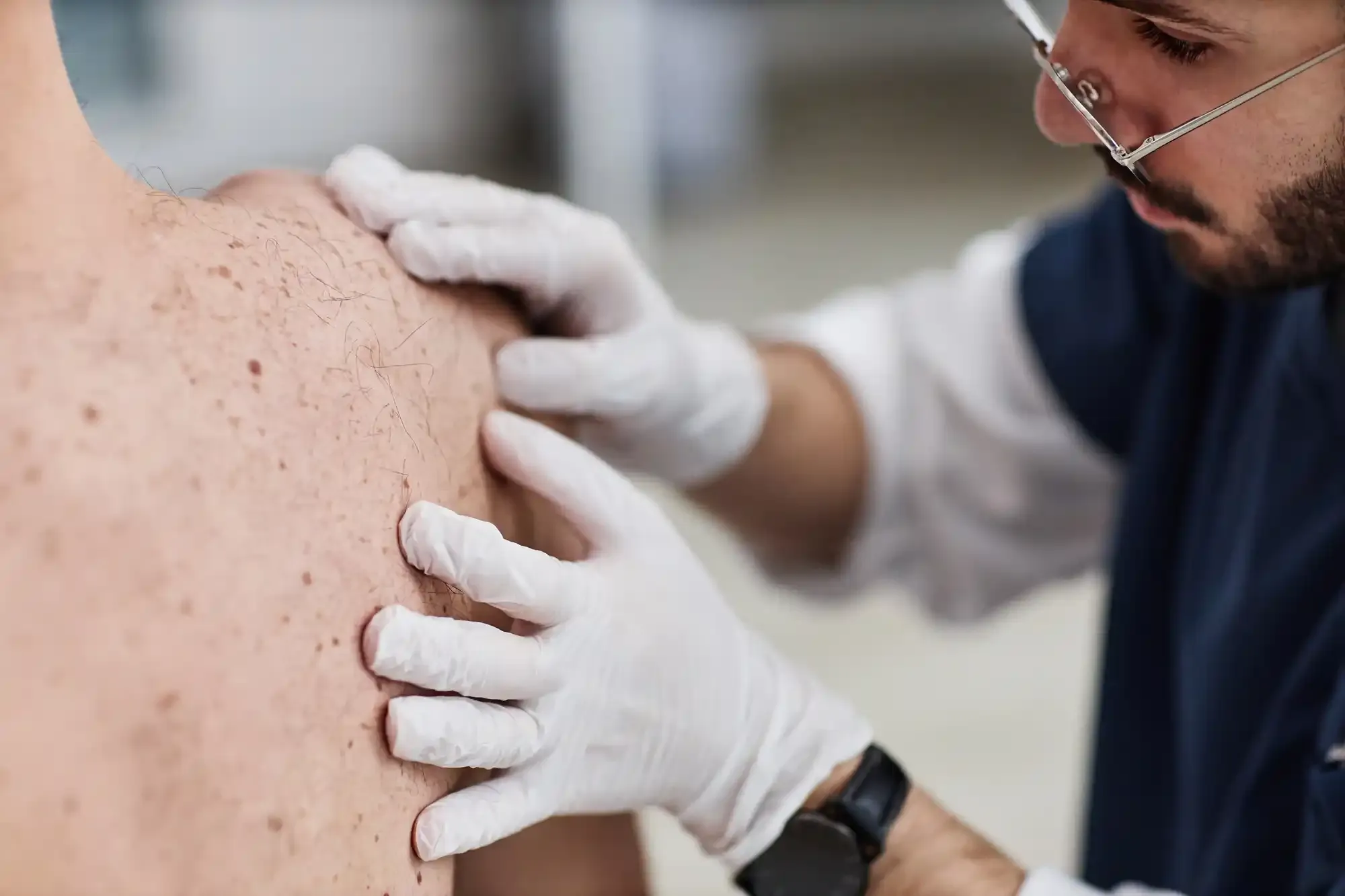 Skin Cancer Check Melbourne CBD